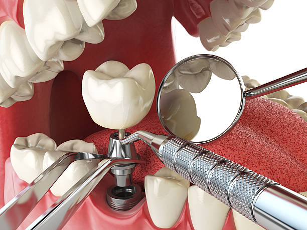 Best Emergency Root Canal Treatment in Shenorock, NY